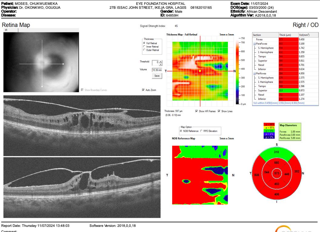 For OCT (Optical Coherence Tomography) Scan: Retinal Damage Proof - Macular Edema